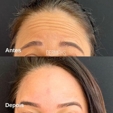 Antes e depois da aplicação do Botox, a toxina botulínica.