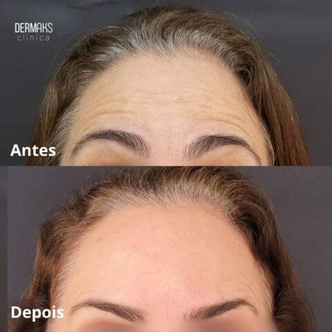 Antes e depois da aplicação do Botox, a toxina botulínica.