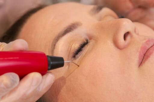 Plasmage é um tratamento estético não invasivo que utiliza energia de plasma para estimular a regeneração da pele.