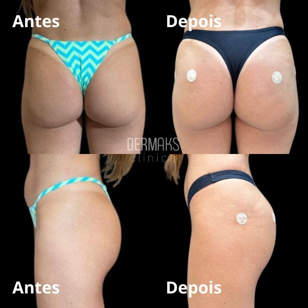 Preenchimento com Ácido Hialurônico | Dermaks